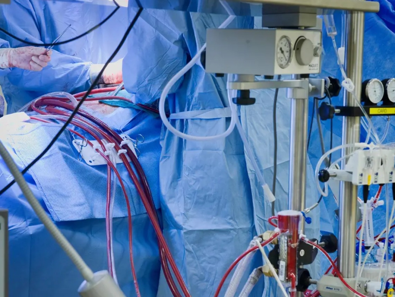 Truyền axit amin làm giảm nguy cơ tổn thương thận cấp tính sau phẫu thuật tim